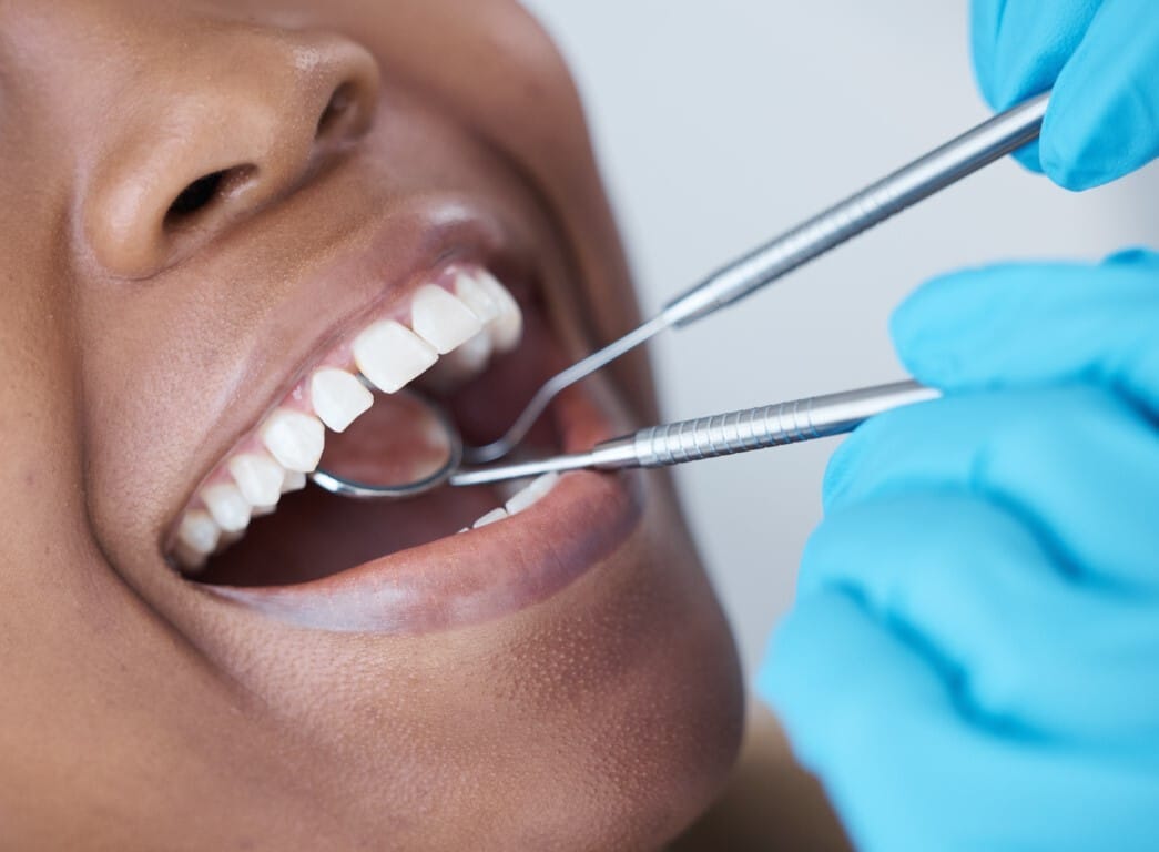 Afty w jamie ustnej – czym są i jak je leczyć?
